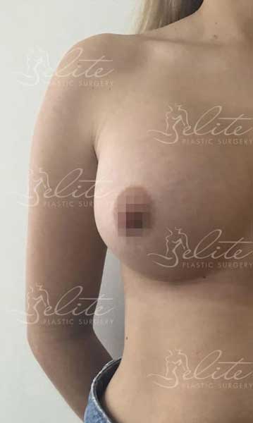 Breast-003-after