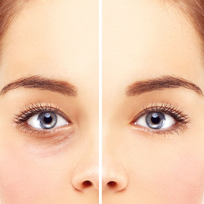 Blepharoplasty Harley Street London