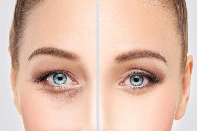 Blepharoplasty Harley Street London