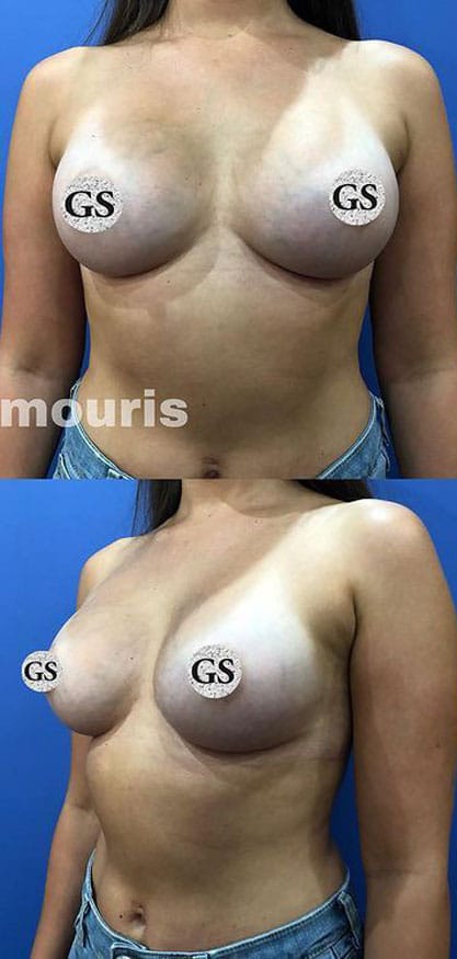 breast-augmentation-after-2