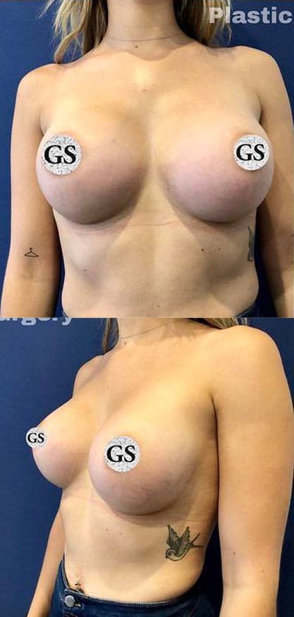 breast-augmentation-after-3