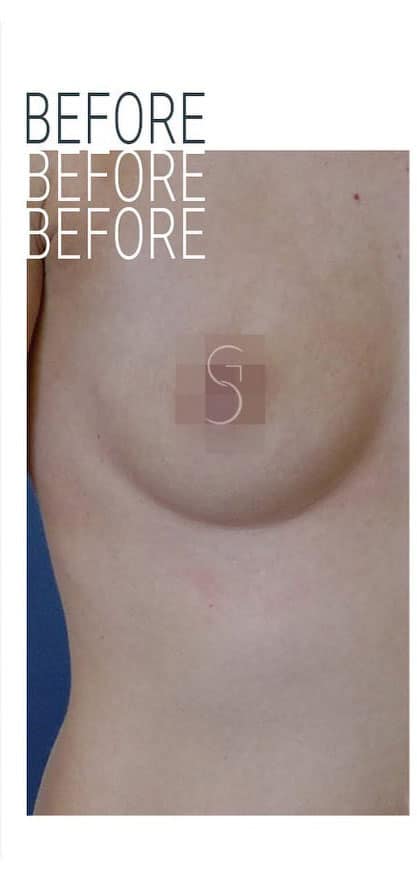 breast-augmentation-before-1
