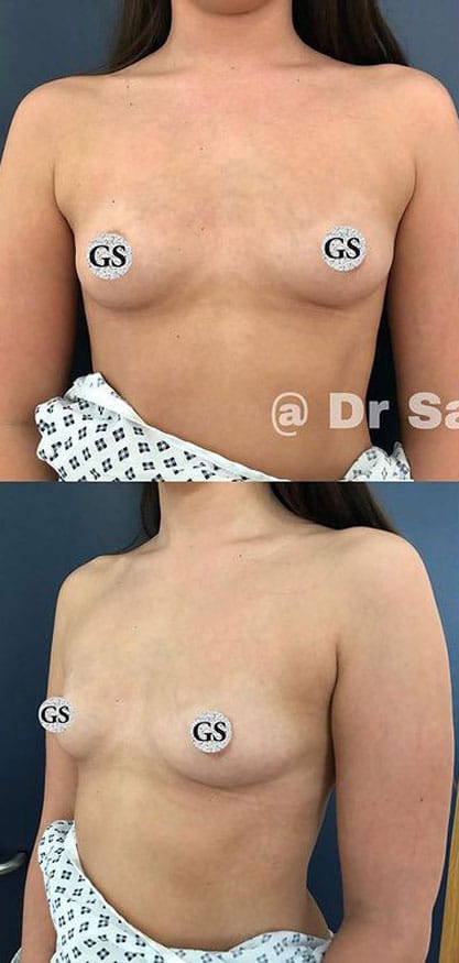 breast-augmentation-before-2