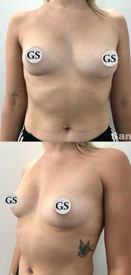 breast-augmentation-before-3