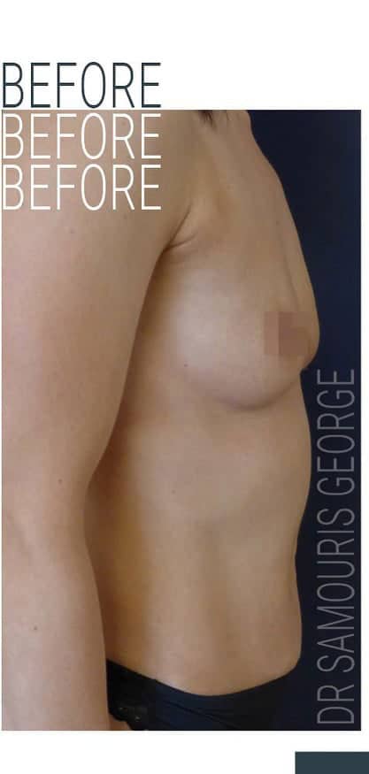 breast-augmentation-before