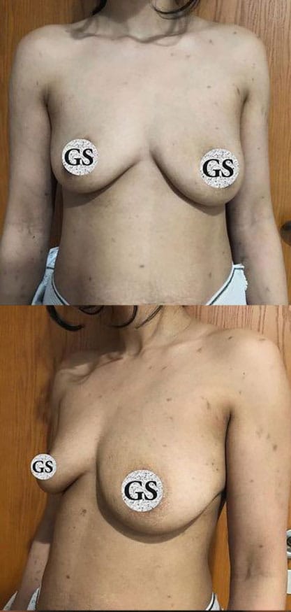 breast-lift-before-1