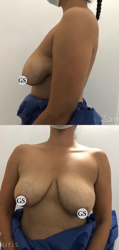 breast-reduction-before-1