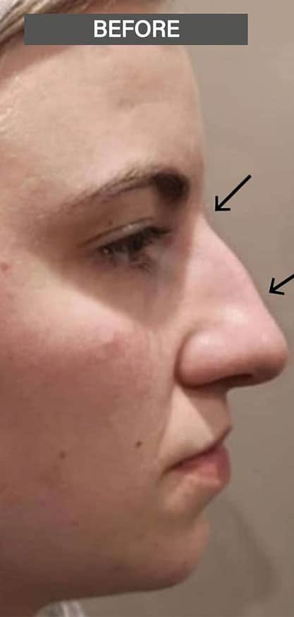 rhinoplasty-before-2