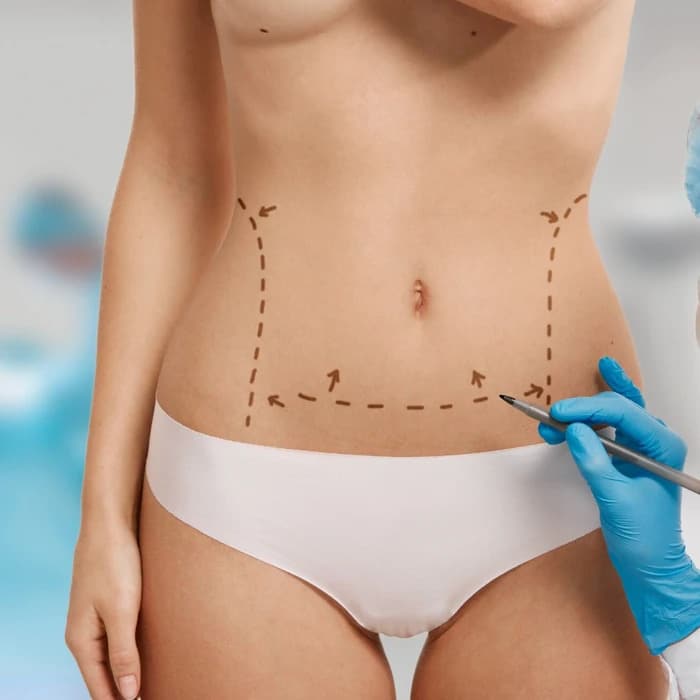 tummy tuck london harley street